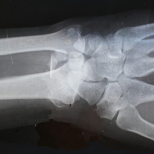 X-ray result, illustrating cloud sharing of radiology images in trauma care