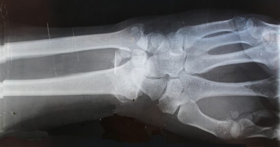 X-ray result, illustrating cloud sharing of radiology images in trauma care